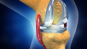 Joint Replacement Surgery