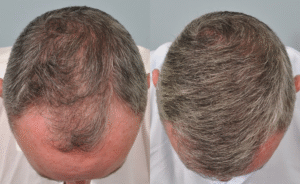 Hair Transplant in Dubai
